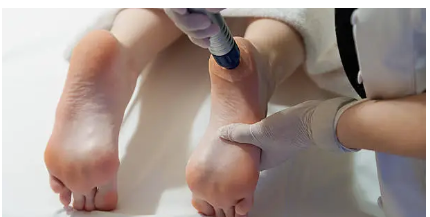shockwave therapy