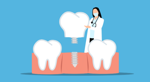 dental implants Adelaide